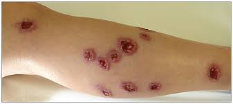 Cutane Leishmaniasis - Ulcus met opgeworpen rand